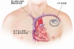 战胜死神！埃里克森植入的ICD是什么？还能从事高强度的运动吗？